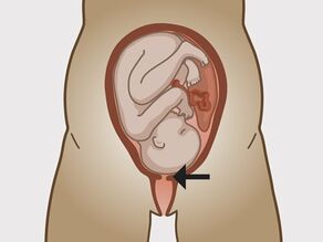 Colul uterin, intrarea în uter, se deschide în timpul contracțiilor.