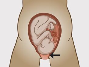 Colul uterin este suficient de dilatat pentru a permite nașterea copilului.