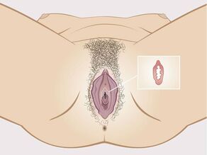 Detaliu al himenului în interiorul vaginului: o formațiune tisulară foarte subțire. Himenul nu este o membrană care sigilează vaginul.