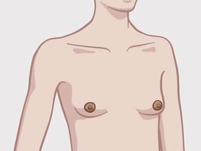 Distintas formas de senos: senos pequeños y puntiagudos. 