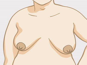 Ulike bryster: mellomstore, pæreformede (lett ovale) bryster.