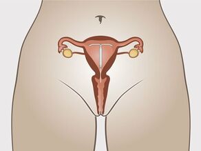 Размещение гормонального ВМК в матке. 2 коротких нити оставлены внутри влагалища, вне полости матки.