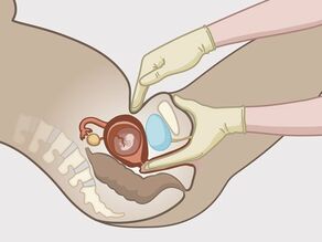 Vajinal muayenenin ayrıntısı: doktor rahim ağzının açılmasını kontrol etmek için birkaç parmağını vajinaya sokar. Dışarıdan rahmin pozisyonunu da kontrol eder. 
