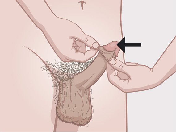 Penis with indication of the glans